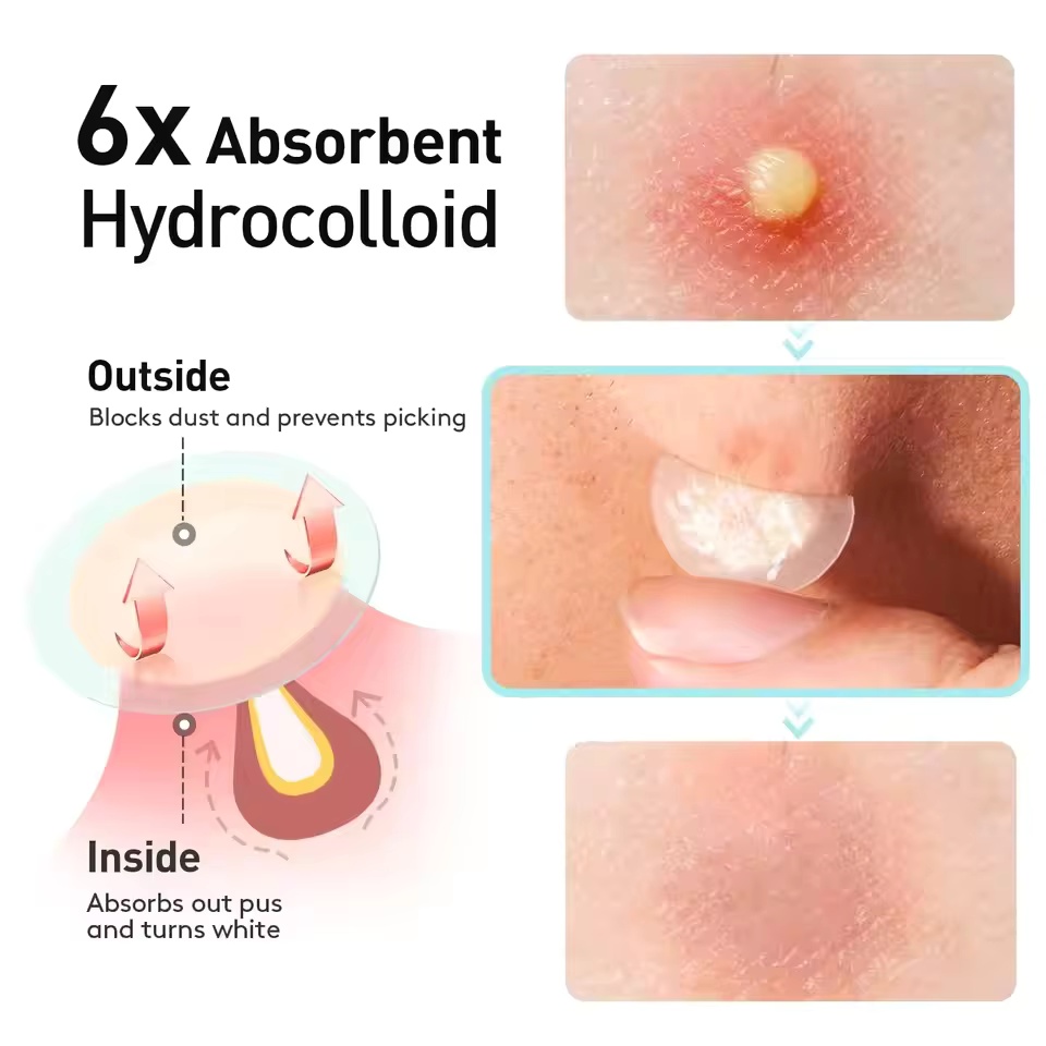 360 pieces/box acne patches -  - Skincare The Originote recension och pris